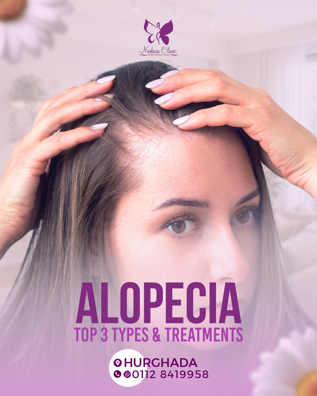 alopecia areata; The most important 3 main types and methods of treatment